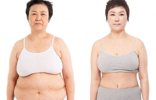 3d liposuction results at jk plastic surgery clinic korea