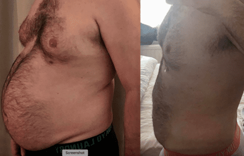 Before and after of a weight loss surgery