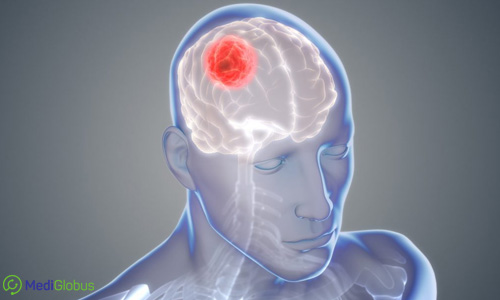 лечение астроцитомы