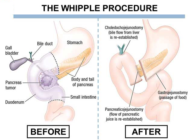 Operations For Pancreatic Cancer