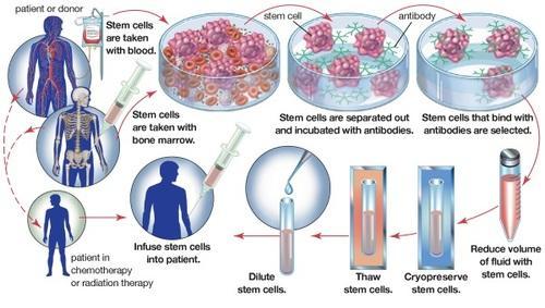How the Bone Marrow Transplantation Is Performed?