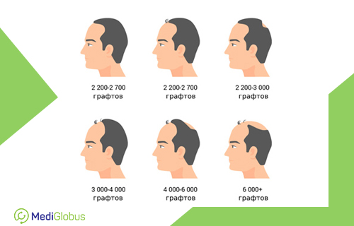 степень облысения и количество необходимых графтов для пересадки