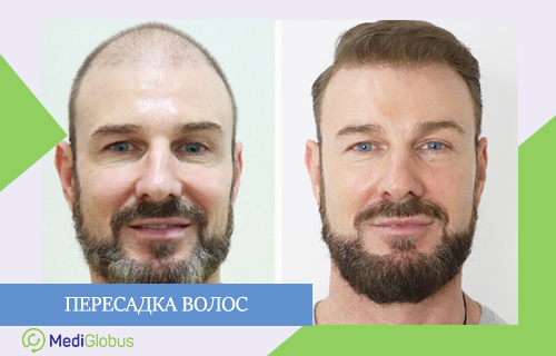 пересадка волос за границей