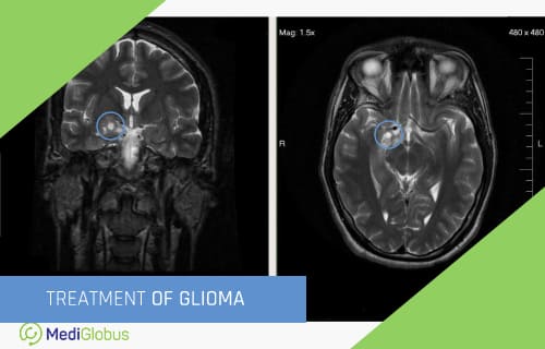 glioma treatment abroad