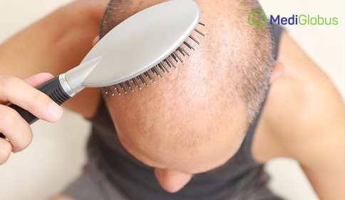 Answers to FAQs about Hair Transplant