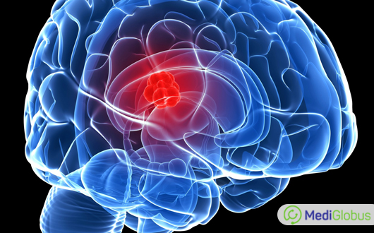 как лечат глиобластому