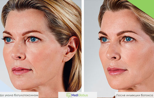 Фото до и после укола ботокса