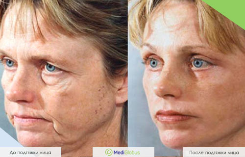 Фото до и после фейслифтинга