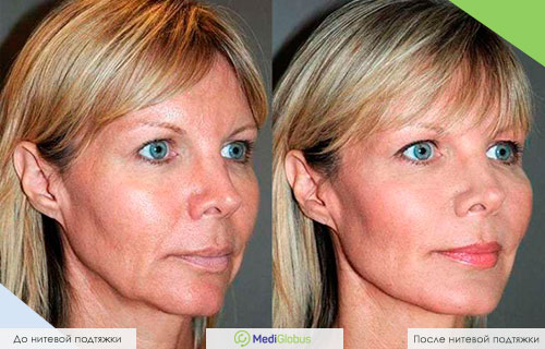 Фото до и после нитевой подтяжки лица