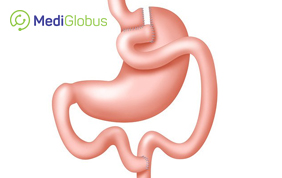 bariatric surgery abroad