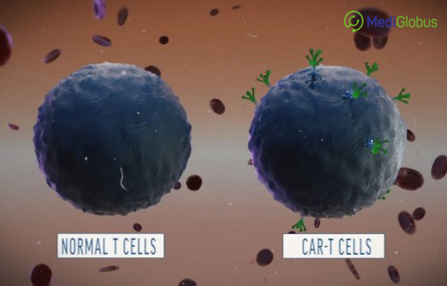 CAR T-клеточная терапия – новый метод лечения рака | MedicGlobus