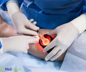 процедура лечения варикоза