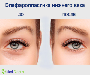 блефаропластика нижнего века
