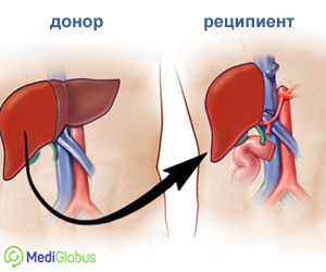 гетеротопическая трансплантация печени