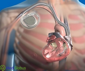 электрокардиостимулятор имплантация