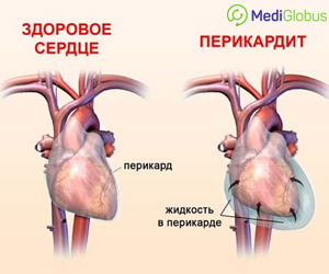 перикардэктомия