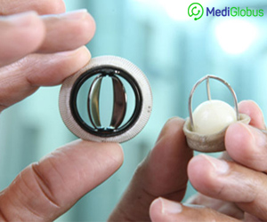 механический тип клапана