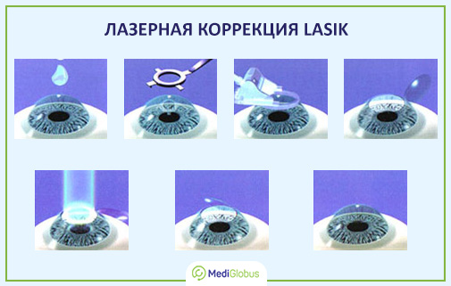 Лазерная коррекция астигматизма. Стоимость процедуры.