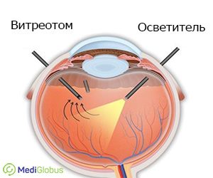 Витрэктомия при разрыве сетчатки