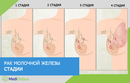 расразвитие рака молочной железы в организме