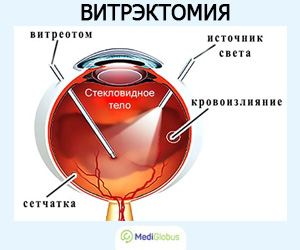 виды витрэктомии