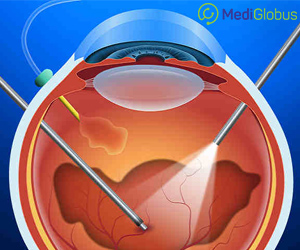полная или частичная витрэктомия в израиле