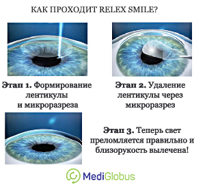 3 этапа процедуры лазерной коррекции relex smile