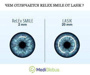 маленький разрез relex smile  в сравнении с lasik