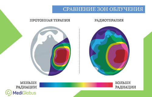 Сравнение поражения мозга радиацией при протонной терапии и радиотерапии