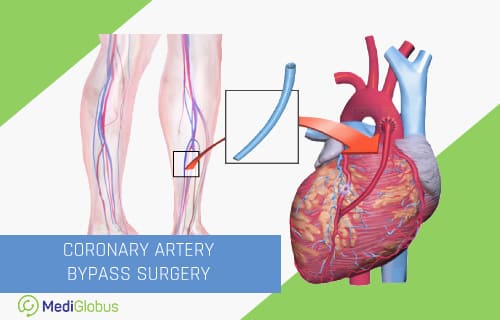 健康・医学 Coronary Artery Bypass Surgery Coronary Artery Bypass Surgery - Heart Surgery - Raney