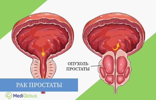 диагностика рака простаты за рубежом фьюжн биопсия