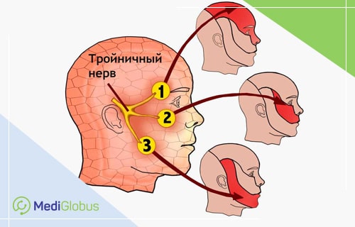 повреждение тройнийничного нерва невралгия