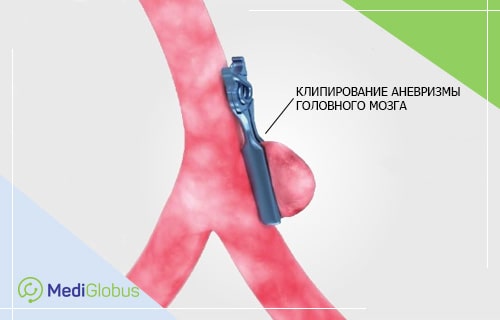 установка клипсы на ножку аневризмы артерии головного мозга
