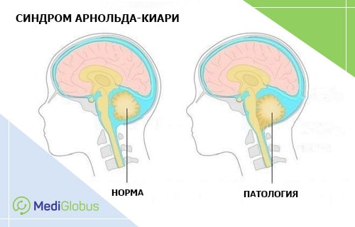 аномалия арнольда киари