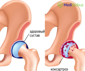 признаки коксатроза сустава