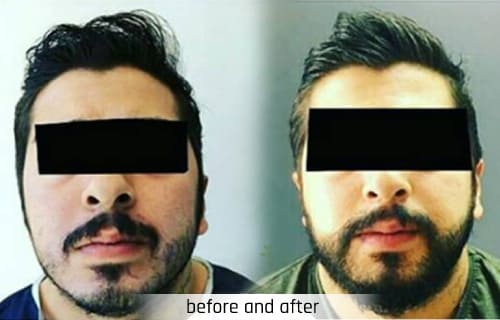 adem and havva beard transplantation turkey istambul before and after