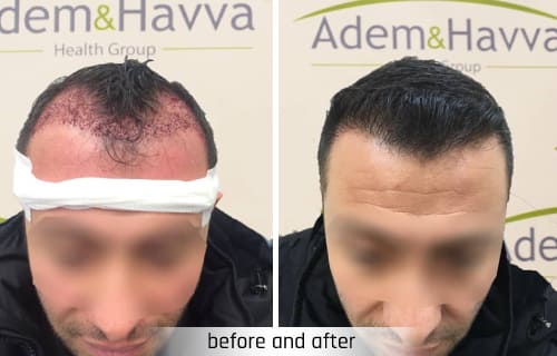 adem and havva hair transplantation turkey istambul before and after