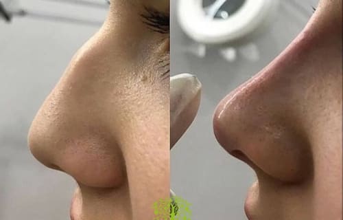 адам и ева ринопластика стамбул турция