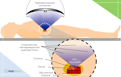 Облучение опухоли с помощью HIFU