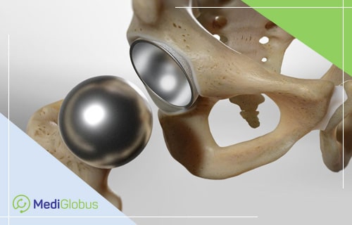 титановый протез сустава бедра