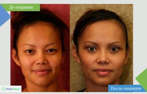 Фото до и после коррекции век в Турции