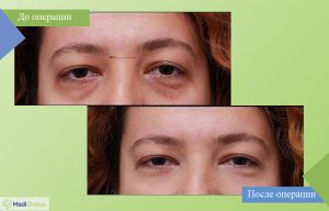 блефаропластика all inclusive фото до после