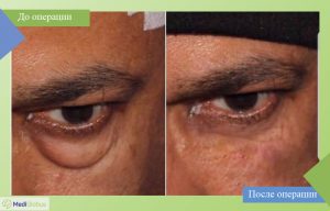 блефаропластика all inclusive фото до после