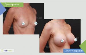 увелчение груди all inclusive фото до после