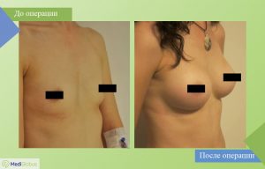 увелчение груди all inclusive фото до после