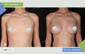 увелчение груди all inclusive фото до после