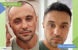 пересадка волос all inclusive фото до после