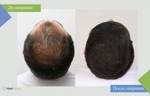 пересадка волос all inclusive фото до после