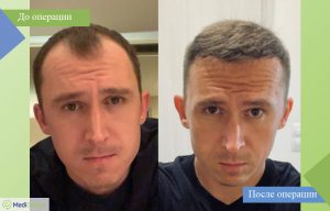 пересадка волос all inclusive фото до после