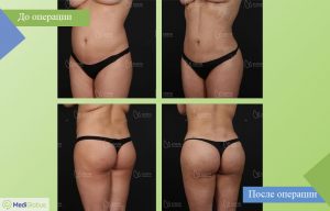 липосакция all inclusive фото до после